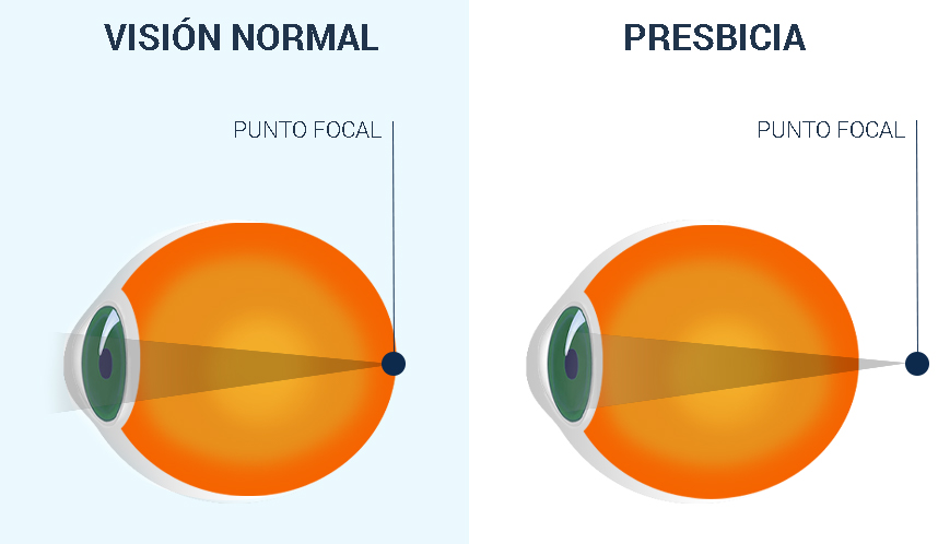 Presbyopia ES