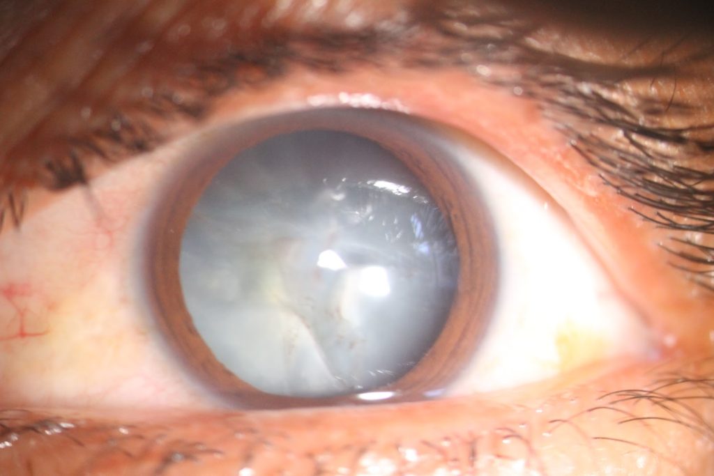 cataratas en los ojos causas y tratamientos