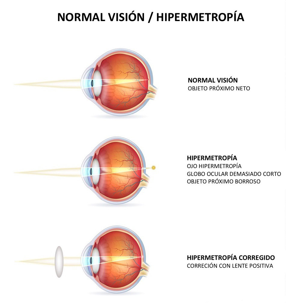 hipermetropia