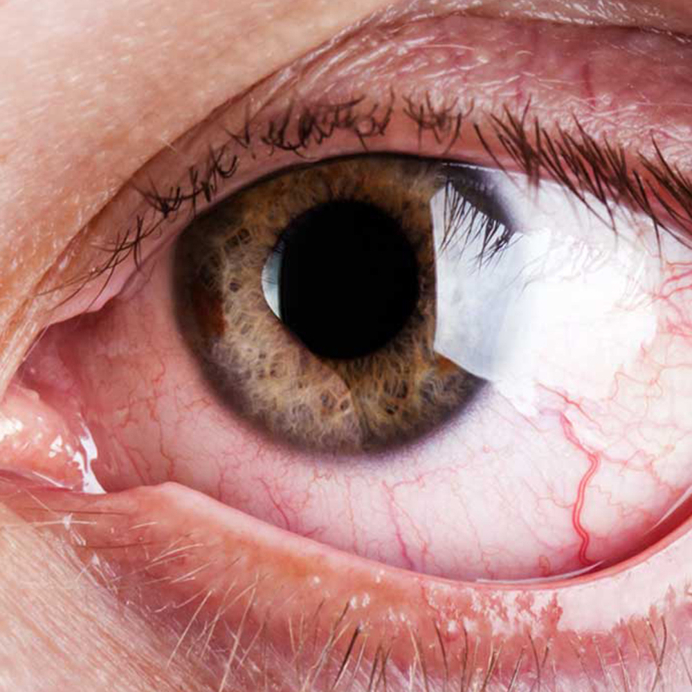 Ojo seco dra