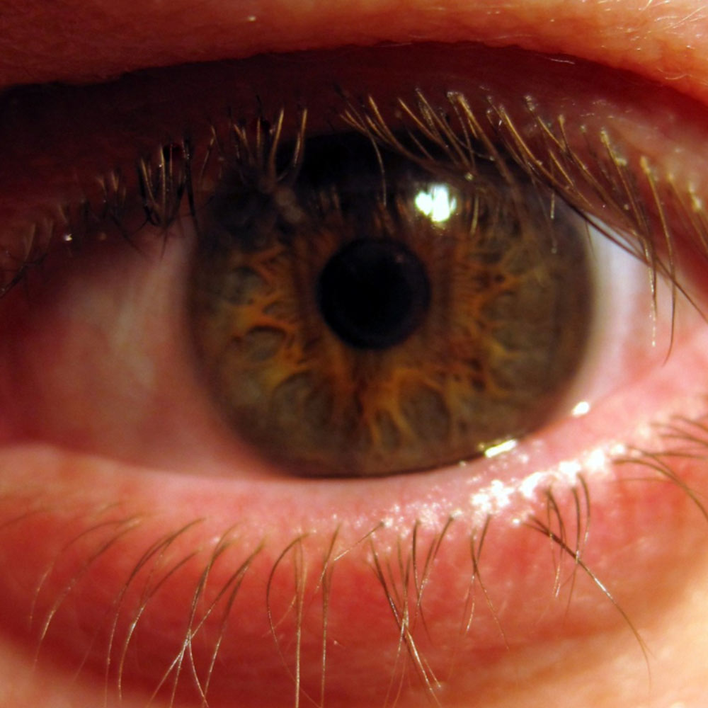 conjuntivitis dra