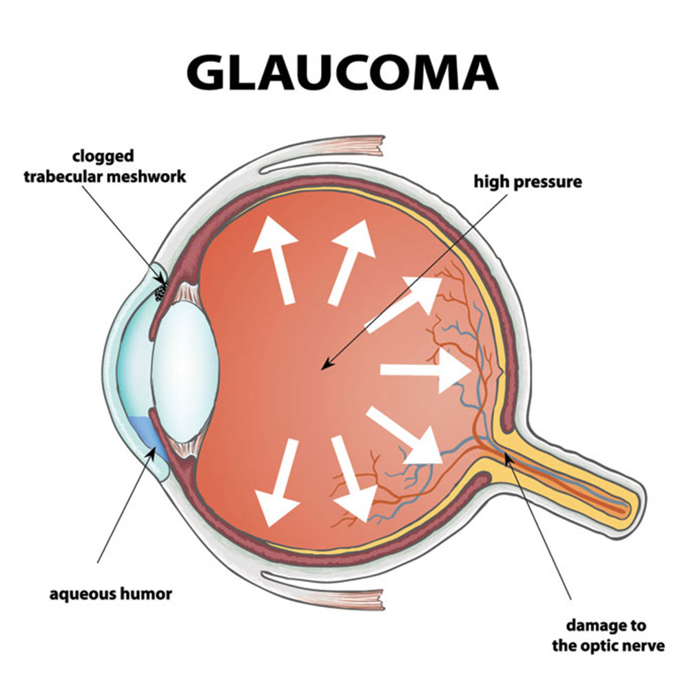 glaucoma
