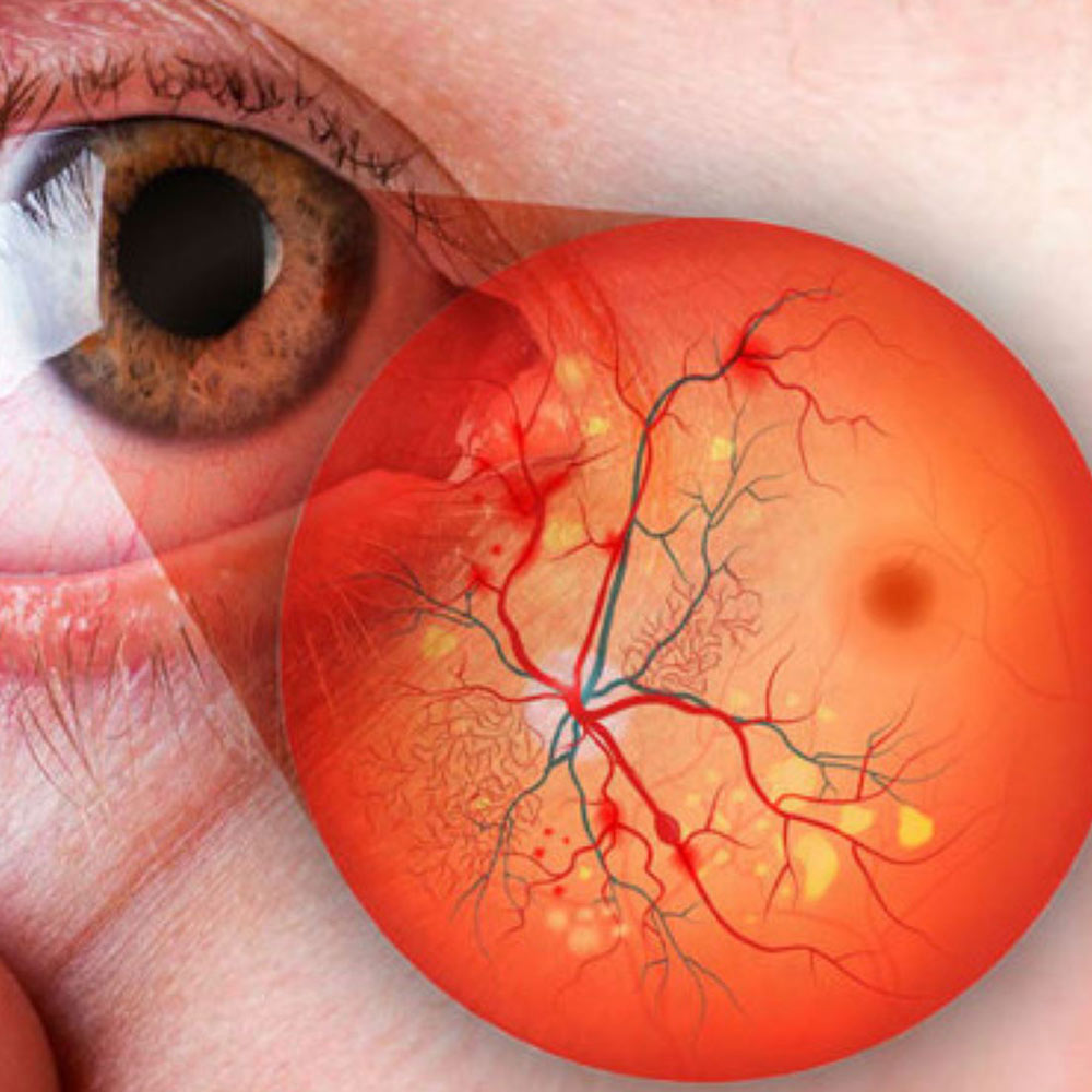retinopatia dra